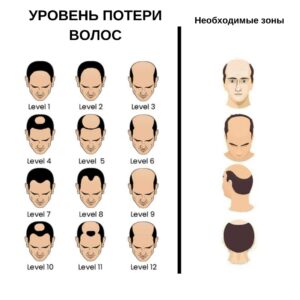 Стоит ли делать пересадку волос